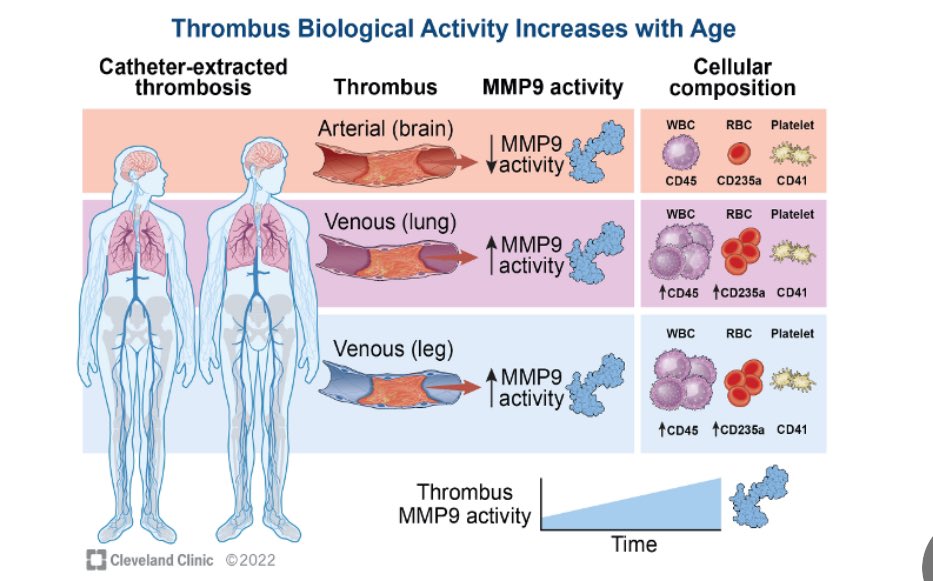 Cleveland Clinic Vascular Medicine (@ccfvascmed) on Twitter photo Cellular and Enzymatic Features of Thrombi in Humans Are Vascular Bed-Dependent. ashpublications.org/bloodvth/artic… <a href="/PulkitChaudhury/">Pulkit Chaudhury</a> <a href="/LebenTefera/">Leben Tefera</a> <a href="/AnuAggarwal86/">Anu Aggarwal</a> <a href="/SVM_tweets/">Society for Vascular Medicine | SVM</a> Cellular and Enzymatic Features of Thrombi in Humans Are Vascular Bed-Dependent. ashpublications.org/bloodvth/artic… <a href="/PulkitChaudhury/">Pulkit Chaudhury</a> <a href="/LebenTefera/">Leben Tefera</a> <a href="/AnuAggarwal86/">Anu Aggarwal</a> <a href="/SVM_tweets/">Society for Vascular Medicine | SVM</a>