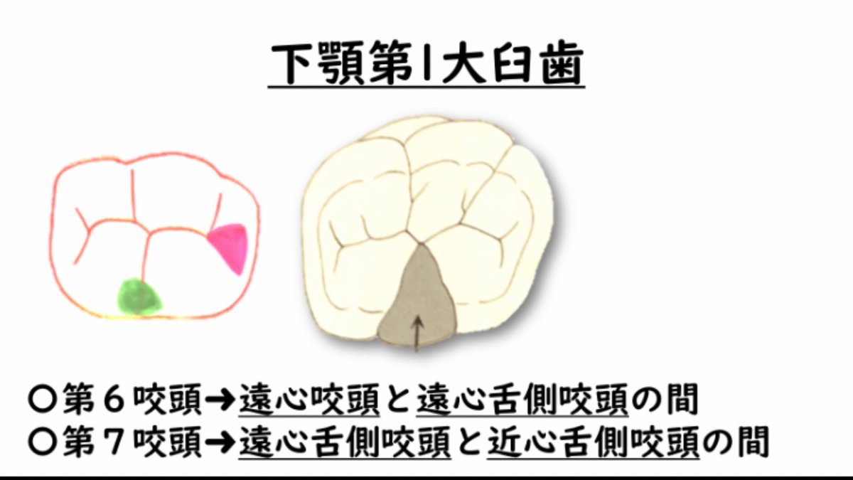歯の解剖のポイント 「下顎第1大臼歯」について。 第6咬頭と、第7咬頭