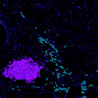 Oscar Maiques (@omaiques) on Twitter photo 🚨 PhD Opportunity! 🚨
Apply your skills in #DeepLearning & #ComputerVision to cancer research! Join us to study B cell dynamics & ECM in melanoma, using cutting-edge imaging & multiomics like #SpatialTranscriptomics.
Apply: colcc.ac.uk/2025-phd-proje…
<a href="/CRUKCOLcentre/">CRUKCOLcentre</a> <a href="/QMBCI/">Barts Cancer Institute (Queen Mary)</a> 🚨 PhD Opportunity! 🚨
Apply your skills in #DeepLearning & #ComputerVision to cancer research! Join us to study B cell dynamics & ECM in melanoma, using cutting-edge imaging & multiomics like #SpatialTranscriptomics.
Apply: colcc.ac.uk/2025-phd-proje…
<a href="/CRUKCOLcentre/">CRUKCOLcentre</a> <a href="/QMBCI/">Barts Cancer Institute (Queen Mary)</a>