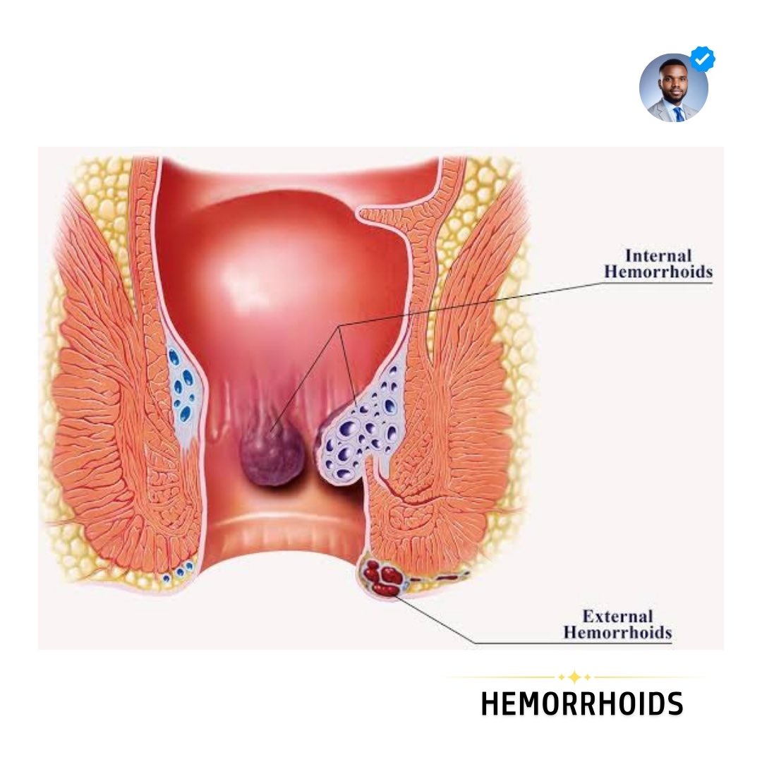 OGreat6's tweet photo. 🔑 LET’S GET THIS OUT OF THE WAY

Hemorrhoids are swollen veins in the rectum or anus that can cause a lot of discomfort. 

They come in two types: internal, which are inside the rectum, and external, which form under the skin around the anus. 

Both types can cause pain, itching, and bleeding, but external ones are usually more painful.