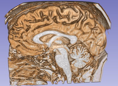 Anthocyanina's tweet photo. got a brain mri last week and got the cd with the files. i can load it in slicer, but i don't know how to export a model of just the brain. has anyone done that? any tips? https://t.co/IqT3gaBGS0