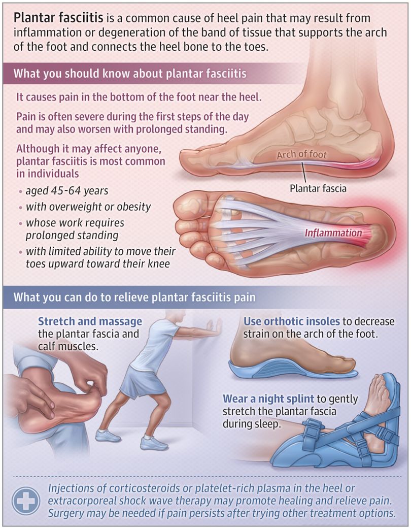 JAMA Patient Education Page - Plantar Fasciitis
 Plantar Fasciitis accounts for more than 1 million US clinic visits per year. People at risk include obesity, jobs w/ prolonged standing buff.ly/4gLtYDv