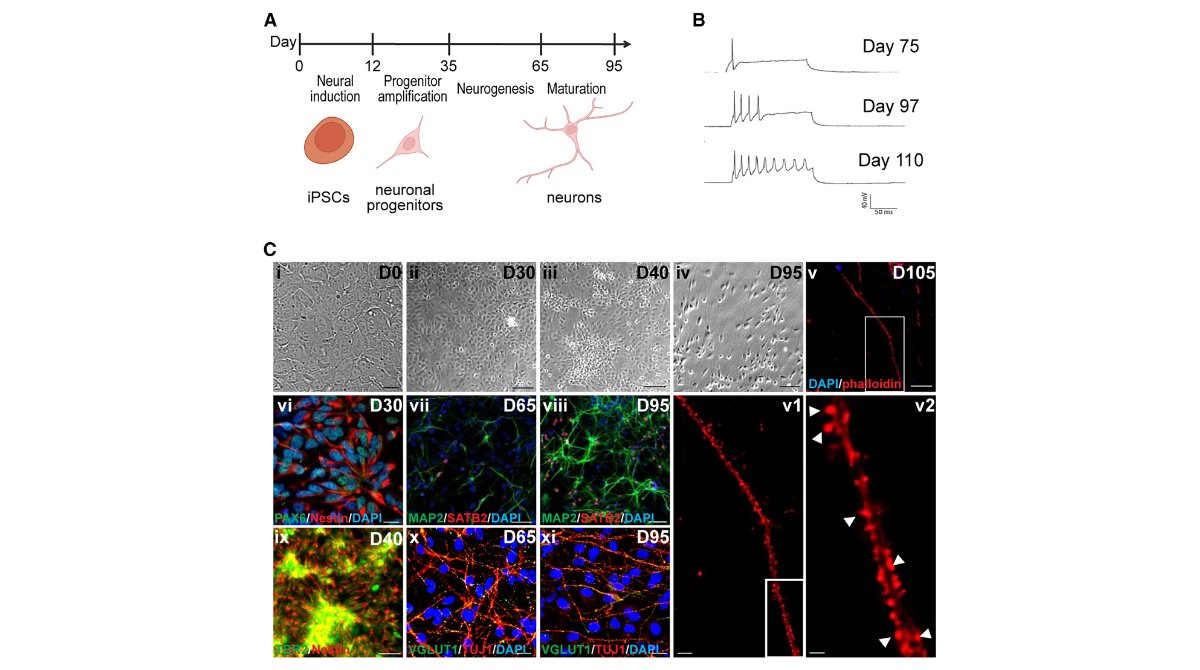 stemcellreports's tweet photo. New research on genetic #priondisease: Abnormal synaptic architecture in iPSC-derived neurons from a multi-generational family with genetic Creutzfeldt-Jakob disease #prion #stemcells 

@BUMedicine @CReM_Boston @ISSCR @CellPressNews @MartinPeraJAX 

https://t.co/KVDDFrBjnk https://t.co/eZRSMNLF1e
