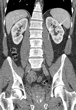 Emergency Medicine News (@emnews) on Twitter photo Innovations have changed nephrolithiasis care, says <a href="/Rick_Pescatore/">Rick Pescatore, D.O.</a>, bc of refinements in imaging & pain strategies.
EPs can give 10 mg ketorolac, which is as effective as higher doses, & magnesium for pain.
Read this! Your pts will thank you! #FOAMed
tinyurl.com/28y4k256 Innovations have changed nephrolithiasis care, says <a href="/Rick_Pescatore/">Rick Pescatore, D.O.</a>, bc of refinements in imaging & pain strategies.
EPs can give 10 mg ketorolac, which is as effective as higher doses, & magnesium for pain.
Read this! Your pts will thank you! #FOAMed
tinyurl.com/28y4k256