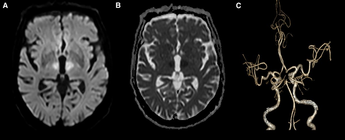 #Stroke Images: A lesion affecting both thalami in the ventromedial nuclei may mediate a disorder of impaired consciousness. #AHAJournals ahajrnls.org/3Y4mpR4
