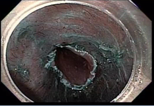 JovaniManol's tweet image. Circumferential ESD for esophageal SCC (pT1b-SM1).
What do you use to prevent stricture?
I injected triamcinolone, put on EoE-like fluticasone treatment and will bring for EGD+dilation in a month.
#ESD #GItwitter #treatcancer
@ASGEendoscopy @ESGE_news @FITE_endoscopy