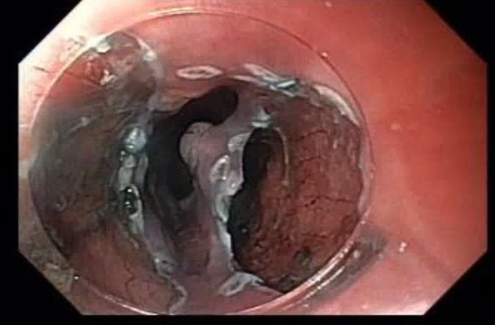 JovaniManol's tweet image. Circumferential ESD for esophageal SCC (pT1b-SM1).
What do you use to prevent stricture?
I injected triamcinolone, put on EoE-like fluticasone treatment and will bring for EGD+dilation in a month.
#ESD #GItwitter #treatcancer
@ASGEendoscopy @ESGE_news @FITE_endoscopy