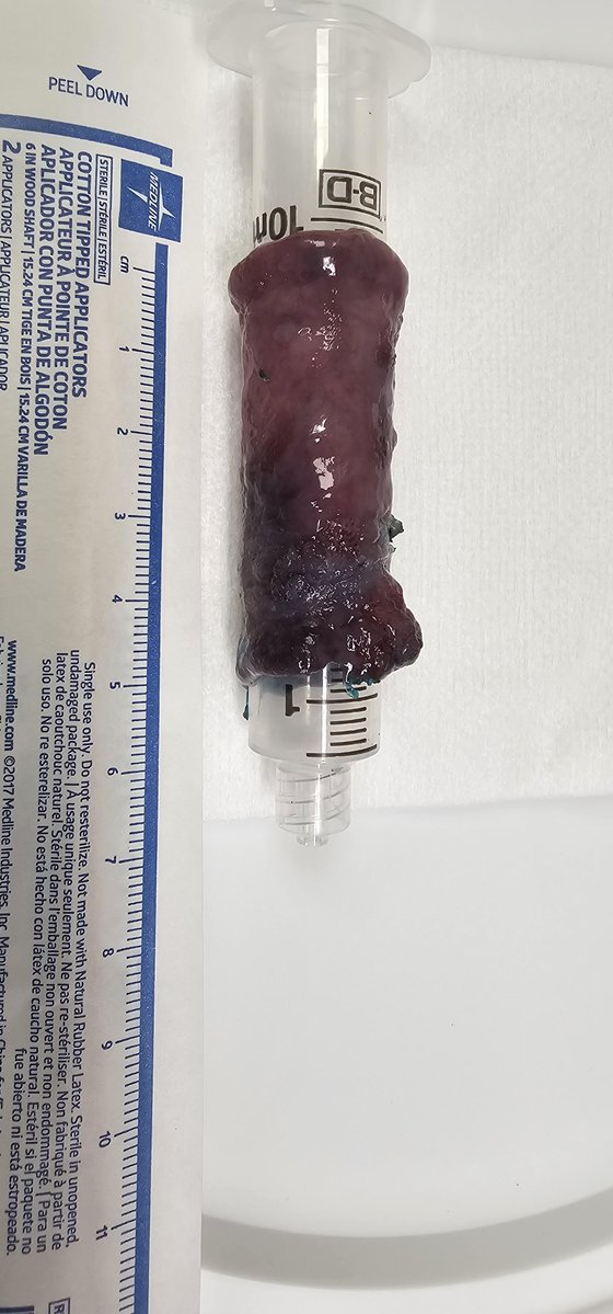 JovaniManol's tweet image. Circumferential ESD for esophageal SCC (pT1b-SM1).
What do you use to prevent stricture?
I injected triamcinolone, put on EoE-like fluticasone treatment and will bring for EGD+dilation in a month.
#ESD #GItwitter #treatcancer
@ASGEendoscopy @ESGE_news @FITE_endoscopy