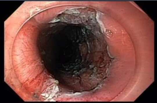 JovaniManol's tweet image. Circumferential ESD for esophageal SCC (pT1b-SM1).
What do you use to prevent stricture?
I injected triamcinolone, put on EoE-like fluticasone treatment and will bring for EGD+dilation in a month.
#ESD #GItwitter #treatcancer
@ASGEendoscopy @ESGE_news @FITE_endoscopy