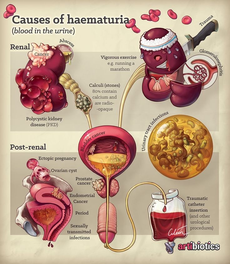 Gazal6849's tweet image. 🔴Causes of Hematuria by artibiotics