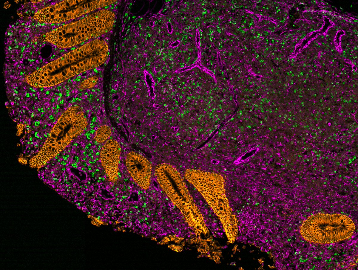 CD8 T cells infiltrating the colonic mucosa in IBD #microscopy