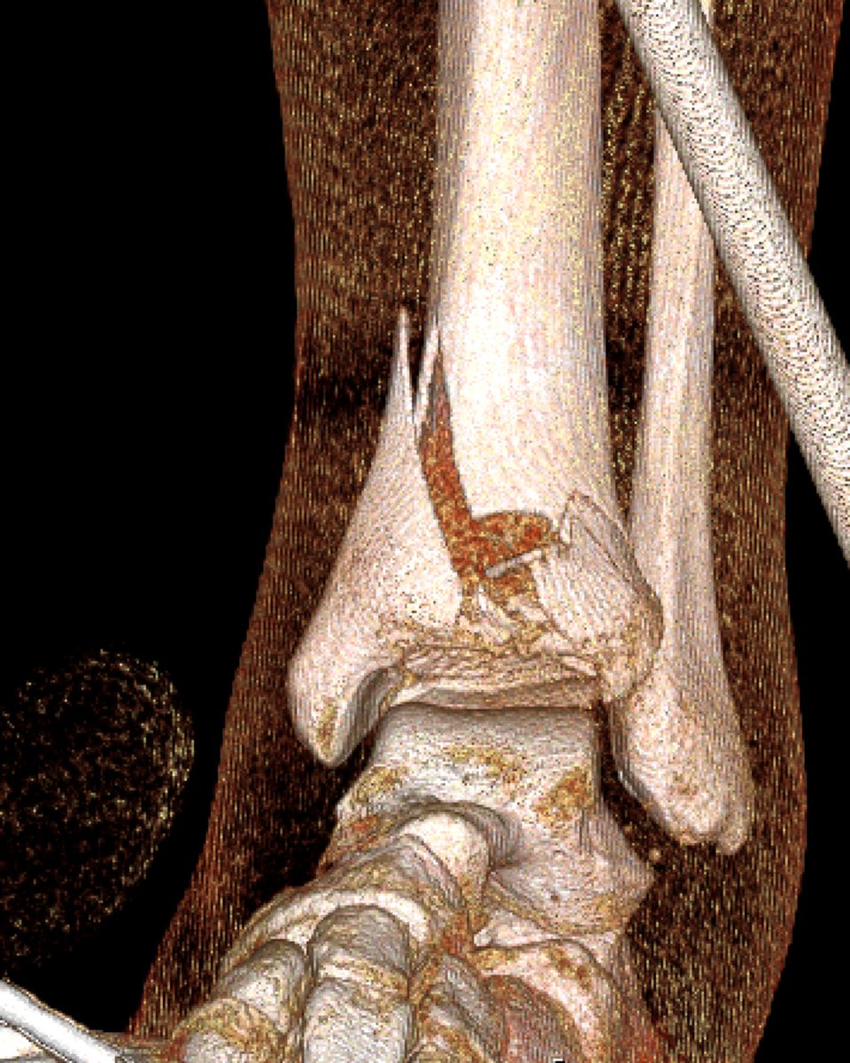 Join us at 8PM (10/2) for a special Fracture Night, Part 1 of 2 on Board Prep. Jennifer Hagen, MD and Michael Polmear, MD will lead other expert Faculty through interactive conversation. Topic: Life &amp; Limb Threatening Injuries
Register today at education.ota.org/education-wedn…