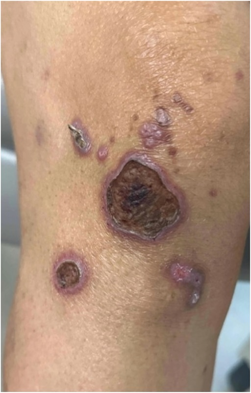 AJDP_Journal's tweet photo. #ClinicalPathologicChallenge
59F with PMH of type 2 diabetes mellitus and end-stage renal disease presented with pruritic purple–brown papules and polymorphic plaques with an erythematous rim after a hemodialysis session
What is your diagnosis?
#dermatopathology #PathTwitter https://t.co/ifXge35Ggo