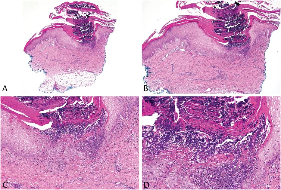 #ClinicalPathologicChallenge

59F with PMH of type 2 diabetes mellitus and end-stage renal disease presented with pruritic purple–brown papules and polymorphic plaques with an erythematous rim after a hemodialysis session

What is your diagnosis?

#dermatopathology #PathTwitter