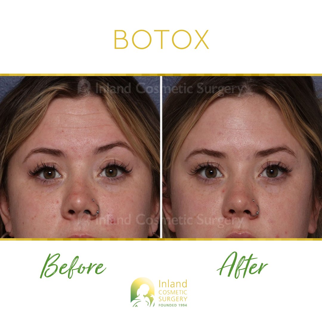 InlandCosmetic's tweet image. #PreventativeBotox for this patient in her mid-20s✨

She received 30 units of Botox injections to her forehead &amp;amp; glabella (lines in this area are often called the &quot;11s&quot;).