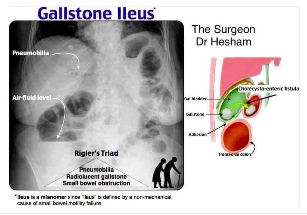 CiruAndes (@ciruandes2) on Twitter photo The Rigler triad of gallstone ileus: pneumobilia, small bowel obstruction and ectopic calcified gallstone, usually in the right iliac fossa blocking the ileocaecal valve 💥⤵️🔪📍👁️! <a href="/PipeCabreraV/">Dr Luis Felipe Cabrera Vargas MD FACS MACC MACCVA</a> <a href="/juliomayol/">Julio Mayol</a> <a href="/SWexner/">Steven D Wexner MD, PhD</a> <a href="/almagoch/">Alberto</a> <a href="/pferrada1/">Paula Ferrada MD FACS FCCM MAMSE</a> <a href="/TomVargheseJr/">Tom Varghese Jr. MD, MS, MBA, FACS, MAMSE 🇺🇸</a> The Rigler triad of gallstone ileus: pneumobilia, small bowel obstruction and ectopic calcified gallstone, usually in the right iliac fossa blocking the ileocaecal valve 💥⤵️🔪📍👁️! <a href="/PipeCabreraV/">Dr Luis Felipe Cabrera Vargas MD FACS MACC MACCVA</a> <a href="/juliomayol/">Julio Mayol</a> <a href="/SWexner/">Steven D Wexner MD, PhD</a> <a href="/almagoch/">Alberto</a> <a href="/pferrada1/">Paula Ferrada MD FACS FCCM MAMSE</a> <a href="/TomVargheseJr/">Tom Varghese Jr. MD, MS, MBA, FACS, MAMSE 🇺🇸</a>