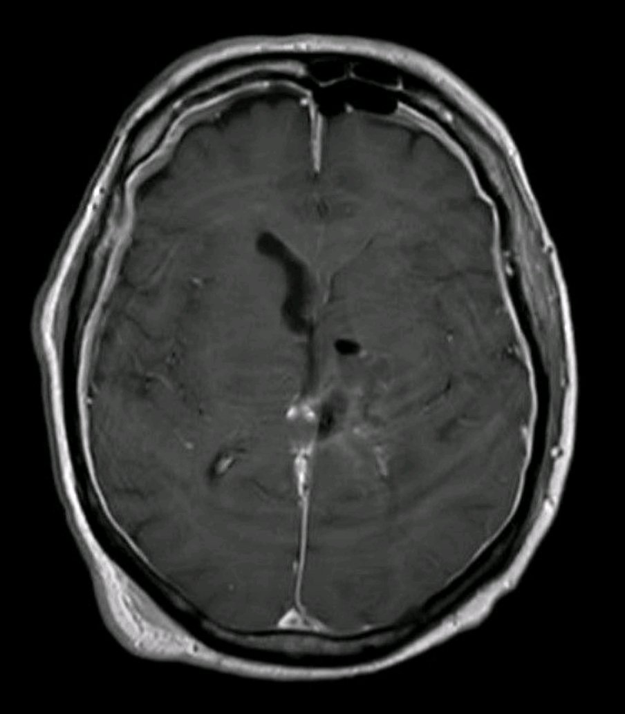 bluecollarneuro's tweet photo. Correct Answer: (A)

Given large size of lesion (3.5 cm) and location within left thalamus and midbrain, XRT alone would have led to: (1) limited oncologic control, (2) potential neurologic morbidity (radiation toxicity/necrosis). https://t.co/G9iqGoSmUp