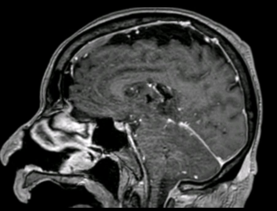 bluecollarneuro's tweet photo. Correct Answer: (A)

Given large size of lesion (3.5 cm) and location within left thalamus and midbrain, XRT alone would have led to: (1) limited oncologic control, (2) potential neurologic morbidity (radiation toxicity/necrosis). https://t.co/G9iqGoSmUp