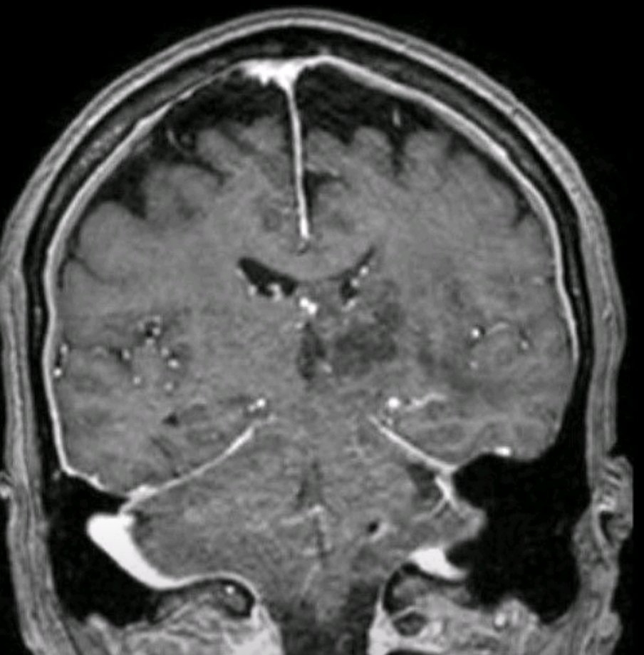 bluecollarneuro's tweet photo. Correct Answer: (A)

Given large size of lesion (3.5 cm) and location within left thalamus and midbrain, XRT alone would have led to: (1) limited oncologic control, (2) potential neurologic morbidity (radiation toxicity/necrosis). https://t.co/G9iqGoSmUp