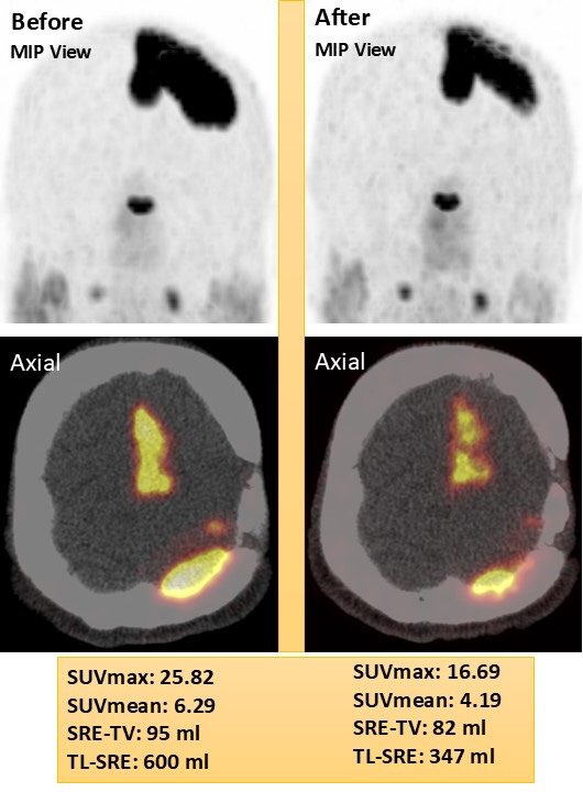 Good response to the combined 177Lu/225Ac-DOTATATE treatment in a patient with recurrent and progressive meningioma –surgery and radiation refractory.   Dizziness, weakness, convulsions, speech, and personality changes totally gone following treatment.

#Meningioma
 #Theranostics