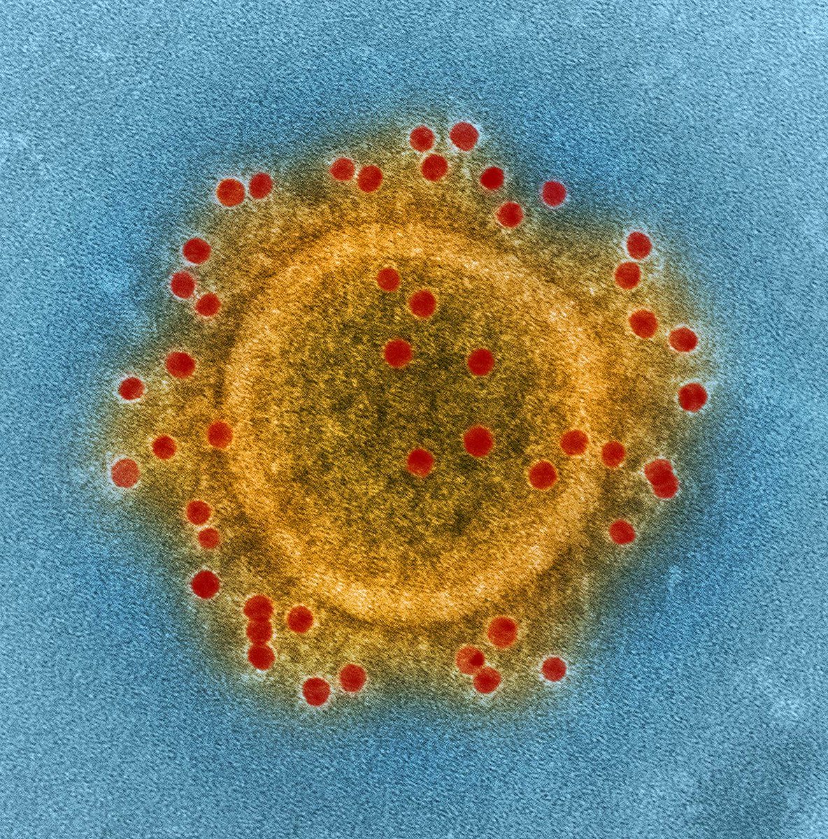 ⚠️ BREAKING: 

New Deadly MERS Coronavirus Case Confirmed in Saudi Arabia, Patient Hospitalized
