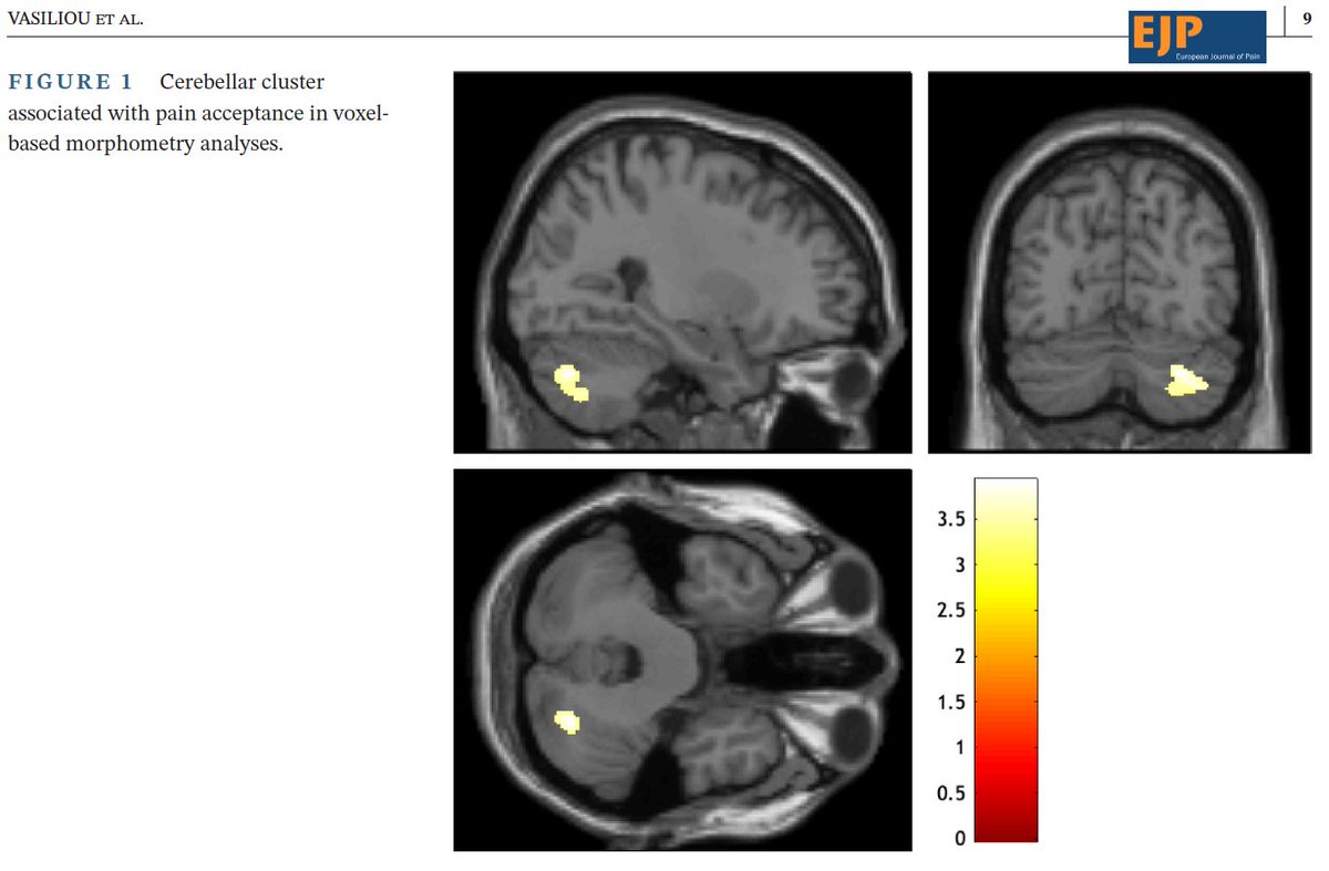 V.S.Vasiliou (@vasiliou_vs) on Twitter photo Should behavioural biomarkers lead the way towards personalizing psy interventions for headaches?
|| Our new fMRI study explored how pain acceptance affects brain activity in individuals with headaches ||
OA here: doi.org/10.1002/ejp.47…
<a href="/RHULPsychology/">Royal Holloway Psychology</a> <a href="/RHUL_Dclinpsy/">RHUL DClinPsy</a> <a href="/myACBS/">Association for Contextual Behavioral Science</a> Should behavioural biomarkers lead the way towards personalizing psy interventions for headaches?
|| Our new fMRI study explored how pain acceptance affects brain activity in individuals with headaches ||
OA here: doi.org/10.1002/ejp.47…
<a href="/RHULPsychology/">Royal Holloway Psychology</a> <a href="/RHUL_Dclinpsy/">RHUL DClinPsy</a> <a href="/myACBS/">Association for Contextual Behavioral Science</a>