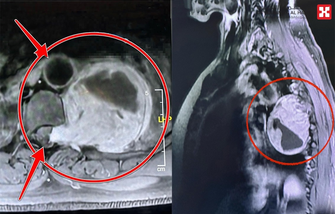 تمدد من النخاع الشوكي وهدد القلب والرئتين .. مستشفى الدكتور سليمان الحبيب بالقصيم يستأصل ورماً ضخماً وزنه 500 جرام

al-jazirah.com/2024/20241003/…