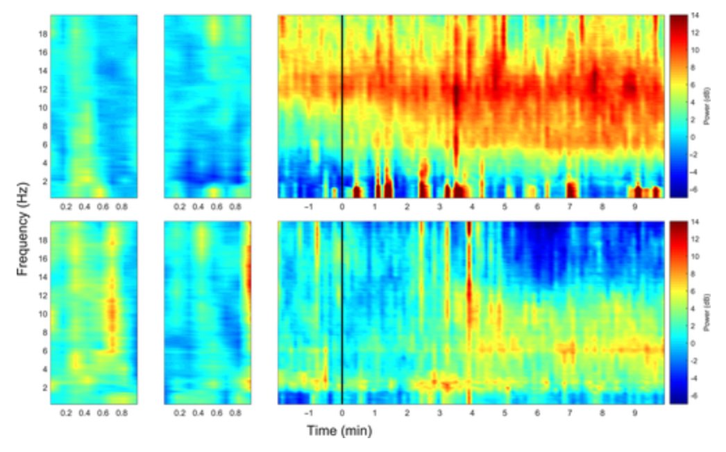 Really interesting set of papers on how speed of  induction induction results in very different initial EEGs (and brain states)

'Top Down' Anaesthesia (Slow)
- Thalamo-cortical interaction 
 - Brainstem function preserved
'Bottom Up' Anaesthesia (Fast)
- Brainstem switched off