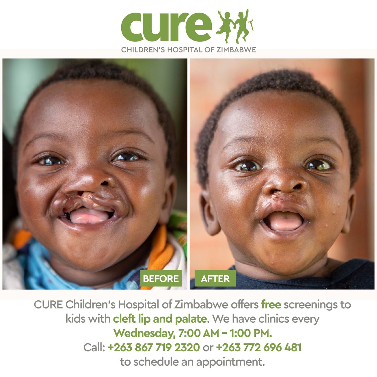 Changing a child's life for the better can be as simple as telling them about the FREE cleft lip and palate clinics at CURE Zimbabwe. We offer these clinics every Wednesday from 7am to 1pm.
Call us today to schedule an appointment: +2638677192320 or +263772696481