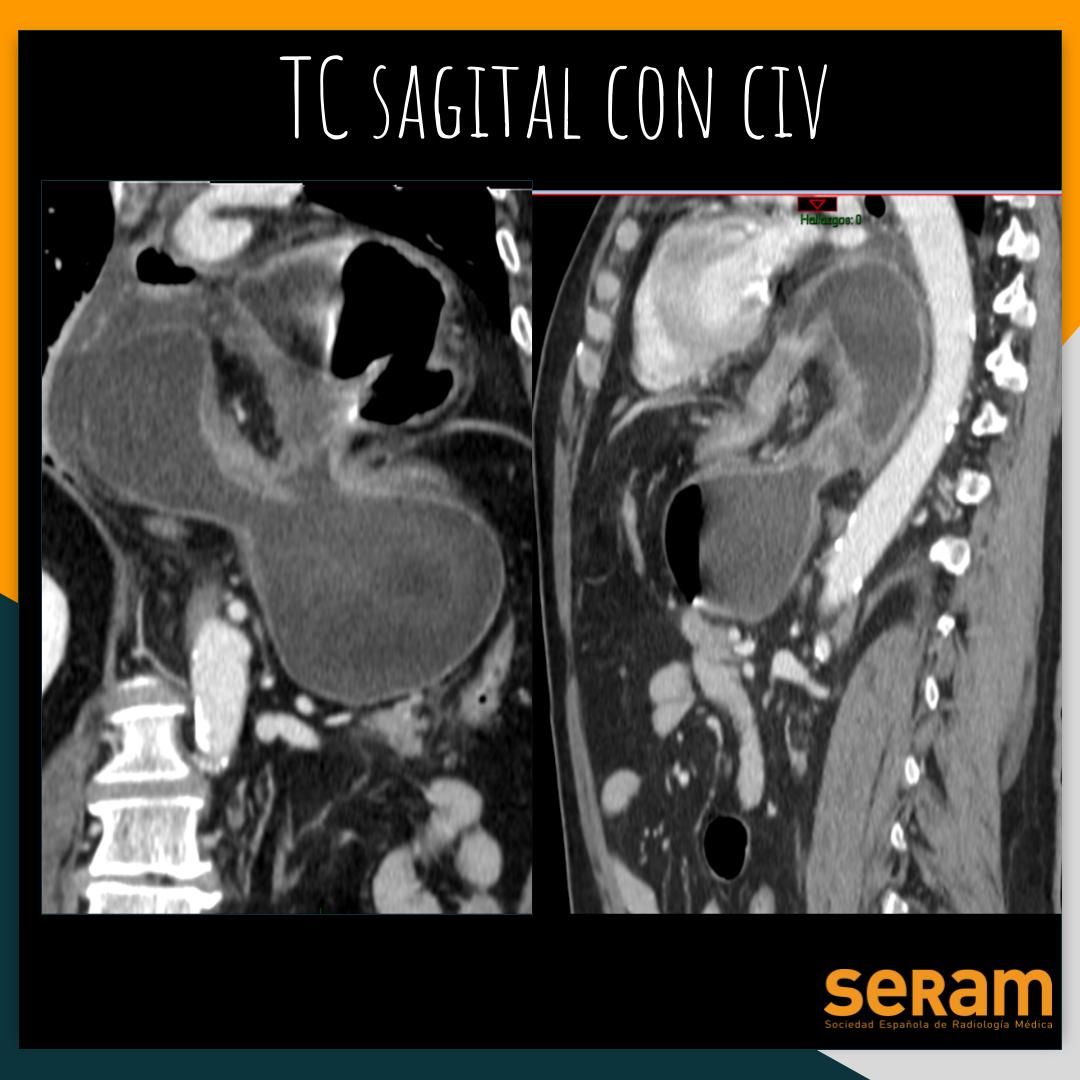 residentesSERAM's tweet photo. ¡Nuevo caso clínico! Hoy Inés García, del H. 12 de Octubre, nos enseña este caso de urgencias. ¿¿Sabrías decir qué observamos en el TC abdominal antes de ver la respuesta?? No esperes más!
@SERAM_RX @seramrx @SERAUWeb @ASER_ERad https://t.co/mc1weBYLDb