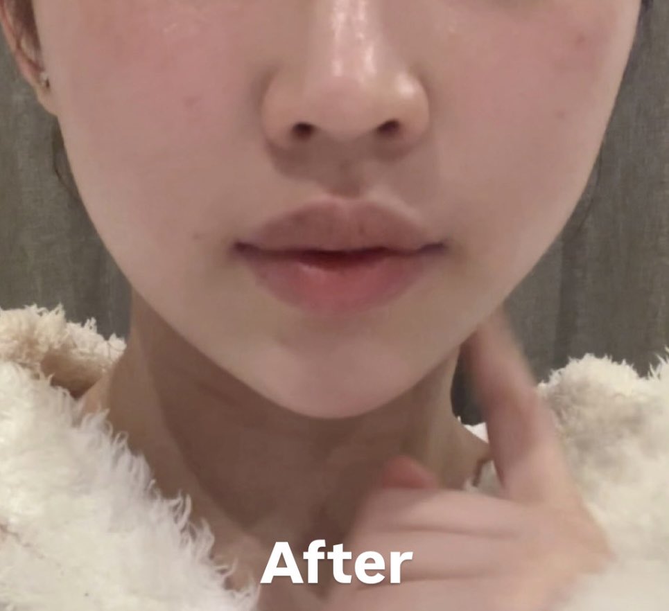 for_hk_'s tweet photo. 顎ヒアル＋ボトめっちゃオススメ💓
左before で右after (どちらも肌加工のみ)
引用元の画像そのまんまに変化したよ🌱ちなみに口横のもたつきはチタニウムリフトで消滅した‼️ https://t.co/sdk6Hc7mDL