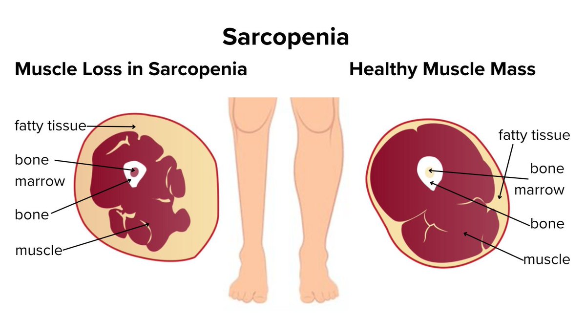 H_Bakkaniy's tweet photo. Bersenam ni bukan semata-mata nak kurus, tapi salah satu kebaikan dia selain memelihara kesihatan kardiovaskular (jantung), bersenam juga boleh melambatkan proses Sarcopenia.

Sarcopenia ni salah satu gejala penuaan bila sel-sel otot makin berkurang akibat penuaan. https://t.co/yHASyFTc2F
