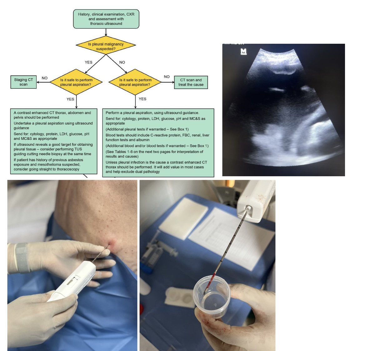 BTS en el Derrame pleural!!
Derrame pleural (sospechoso de malignidad)-ultrasonido-Pleura engrosada/implante pleural-Biopsia pleural = Adenocarcinoma.