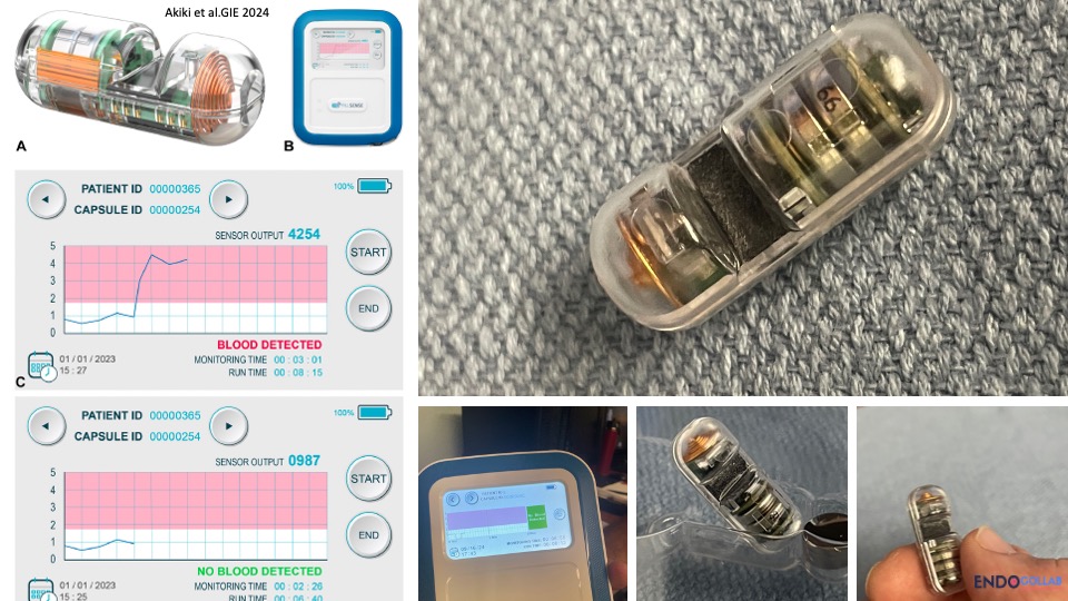 theendoscopist's tweet photo. Technical Review: PillSense ®, a Novel Swallowable Capsule to Detect Upper Gastrointestinal Bleeding

Read Now: https://t.co/U1Beh9yfHf https://t.co/IXRokOct2c