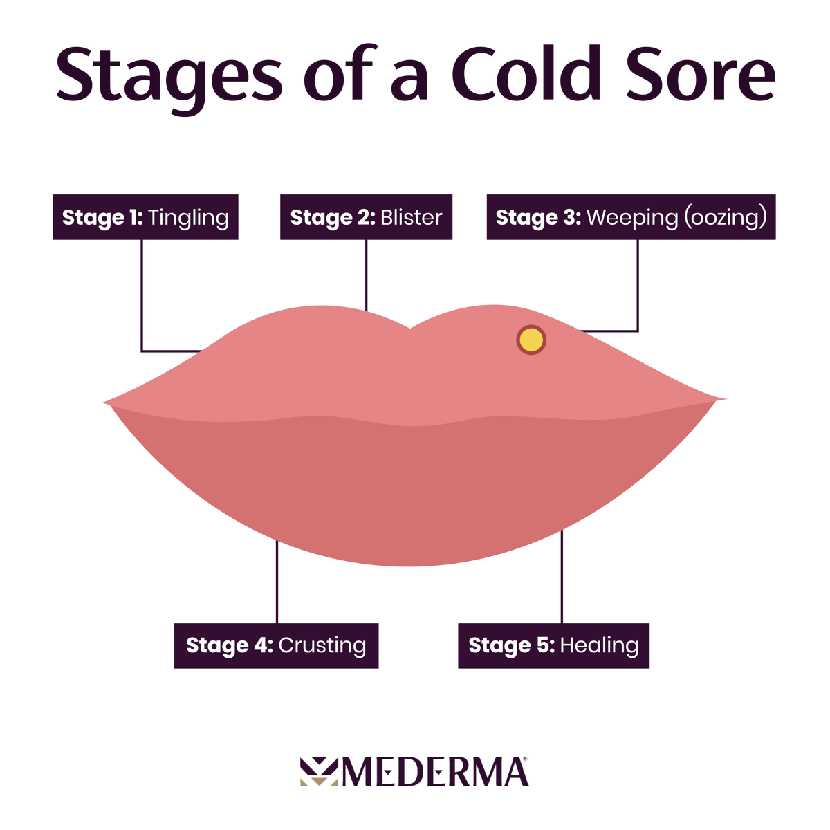 Mederma's tweet photo. From tingle to heal, know the stages. 

#ColdSores #Mederma #ColdSoreRelief https://t.co/Nekv2l0Tam