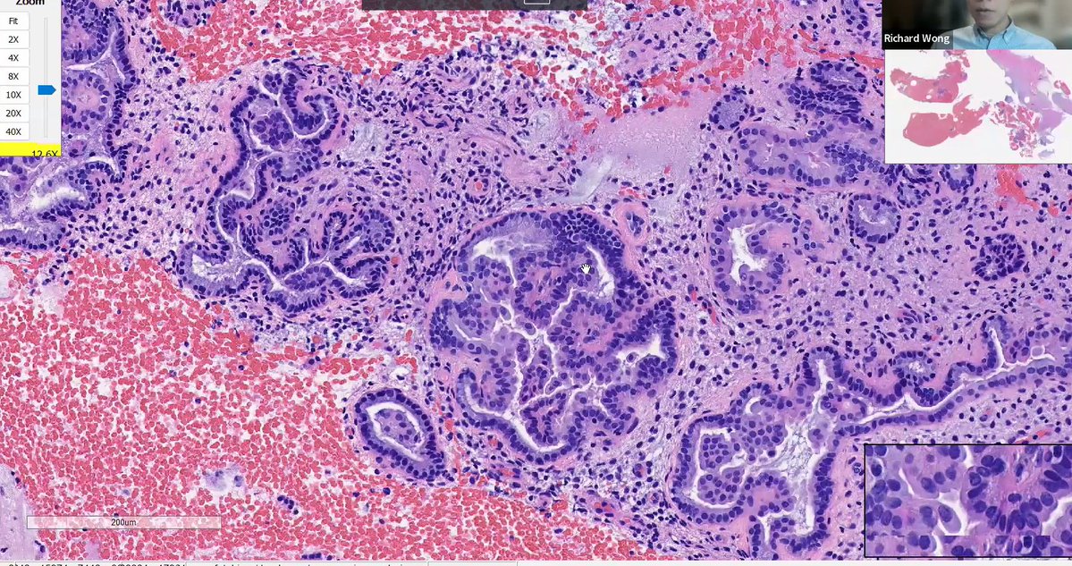Janiranavarro's tweet image. Mucinous lesions of the endometrium
Papillary endometrial proliferations with mucinous metaplasia
-Mucinous glands with intraglandular simple papillary structures
How would you sign out this endometrial biopsy?
See next post 👇
Dr. Wong #isgyp #PathTwitter #PathX #pathresidents…