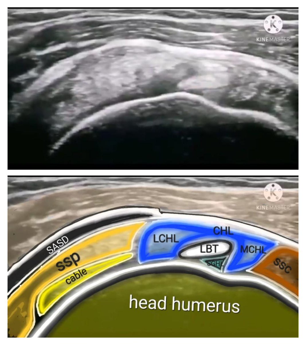 SASD bursa from rotator cuff interval 🧐🧐