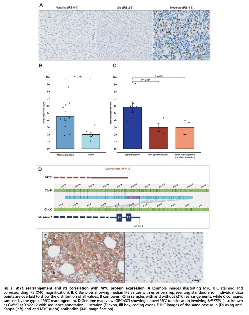 Robert Z. Orlowski (@myeloma_doc) on Twitter photo #Myeloma Paper of the Day: Optical genome mapping in conjunction w/ FISH, karyotyping & NGS detects MYC rearrangements in 43.3% of patients, and MYC protein over-expression in 72.7% of these cases, especially w/ translocations involving Ig loci: pubmed.ncbi.nlm.nih.gov/39304649/. #mmsm #Myeloma Paper of the Day: Optical genome mapping in conjunction w/ FISH, karyotyping & NGS detects MYC rearrangements in 43.3% of patients, and MYC protein over-expression in 72.7% of these cases, especially w/ translocations involving Ig loci: pubmed.ncbi.nlm.nih.gov/39304649/. #mmsm