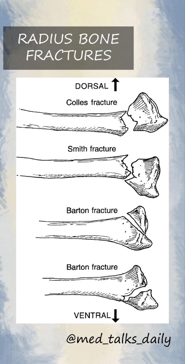 Radius fractures