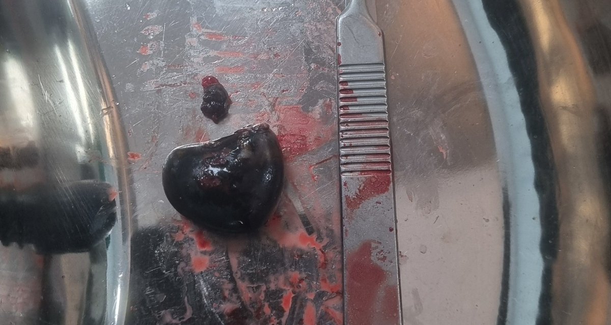 akhadam77's tweet photo. Bismillaah
Tangkapan beberapa hari yang lalu. 
Batu di ureter (saluran antara ginjal dan kandung kemih) yang saat diambil harus dibedah karena batunya sangat keras (bisa terlihat dari warnanya yang hitam).

Pasien ini sehari2 nyaris tidak bergejala. Hanya terkadang pegal di pinggangnya. 
Saat ini semakin sering ada kasus silent stone. Proses pembentukan batu berlangsung perlahan dan bertahap. Sehingga tidak pernah muncul nyeri hebat. Bagi teman2 yang beresiko terjadi batu ginjal (tinggal di daerah dgn cuaca panas, minum air yang mengandung kapur sehari2, konsumsi makanan tinggi kolesterol sementara jarang olahraga, pekerjaan yang memerlukan duduk lama atau sering berkeringat, jarang minum air putih dan sering menahan kencing), sebaiknya rajin melakukan medical check up dengan usg abdomen (perut) paling tidak 1 tahun sekali. Sehingga bila terjadi batu ginjal bisa cepat diketahui dan diberikan obat.

Wallahu a'lam bisawwab