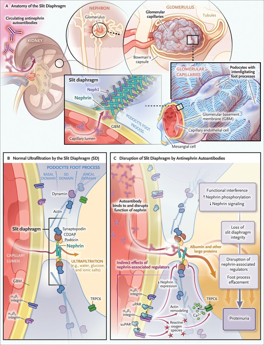 Antinephrin Autoantibody Podocytopathy from <a href="/Tobias_B_Huber/">Tobias B. Huber</a> 
#RKDSummit #Nephpearls

📌 Antinephrin Autoantibodies are associated with disease
   ☑️ 69% in active minimal change disease (MCD) pre-treatment
   ☑️ 90% in active idiopathic nephrotic syndrome pre-treatment

📌