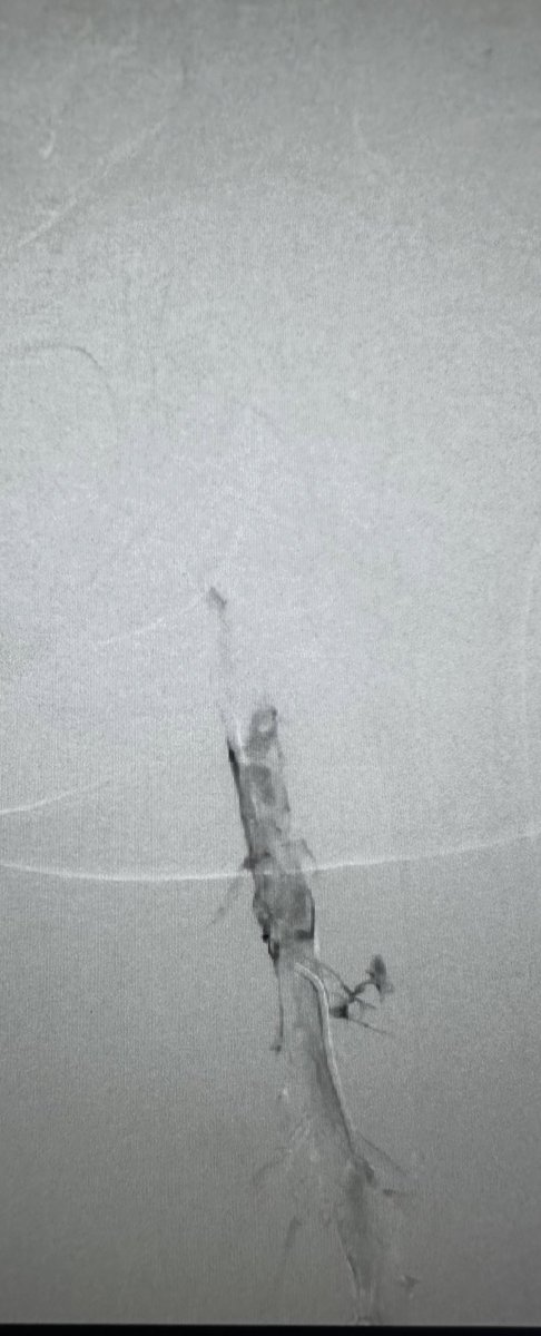 AustinBourgeois's tweet photo. Have seen this several times over the years:  uterine fibroids creating venous compression and DVT.  Treated with mechanical thrombectomy and fibroid embolization #iRad https://t.co/BIgeMCB8rM