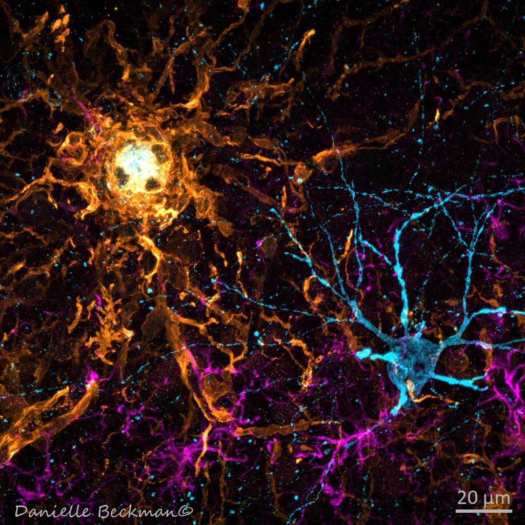 What is neuroinflammation, and will we be able to learn to control it one day? The image below shows a neuron being attacked (or helped?) by glial cells. 
Markers: neuron/pTau-blue, microglia/iba1-gold,  astrocytes/gfap-purple. What kind of help makes things worse? #neuroscience