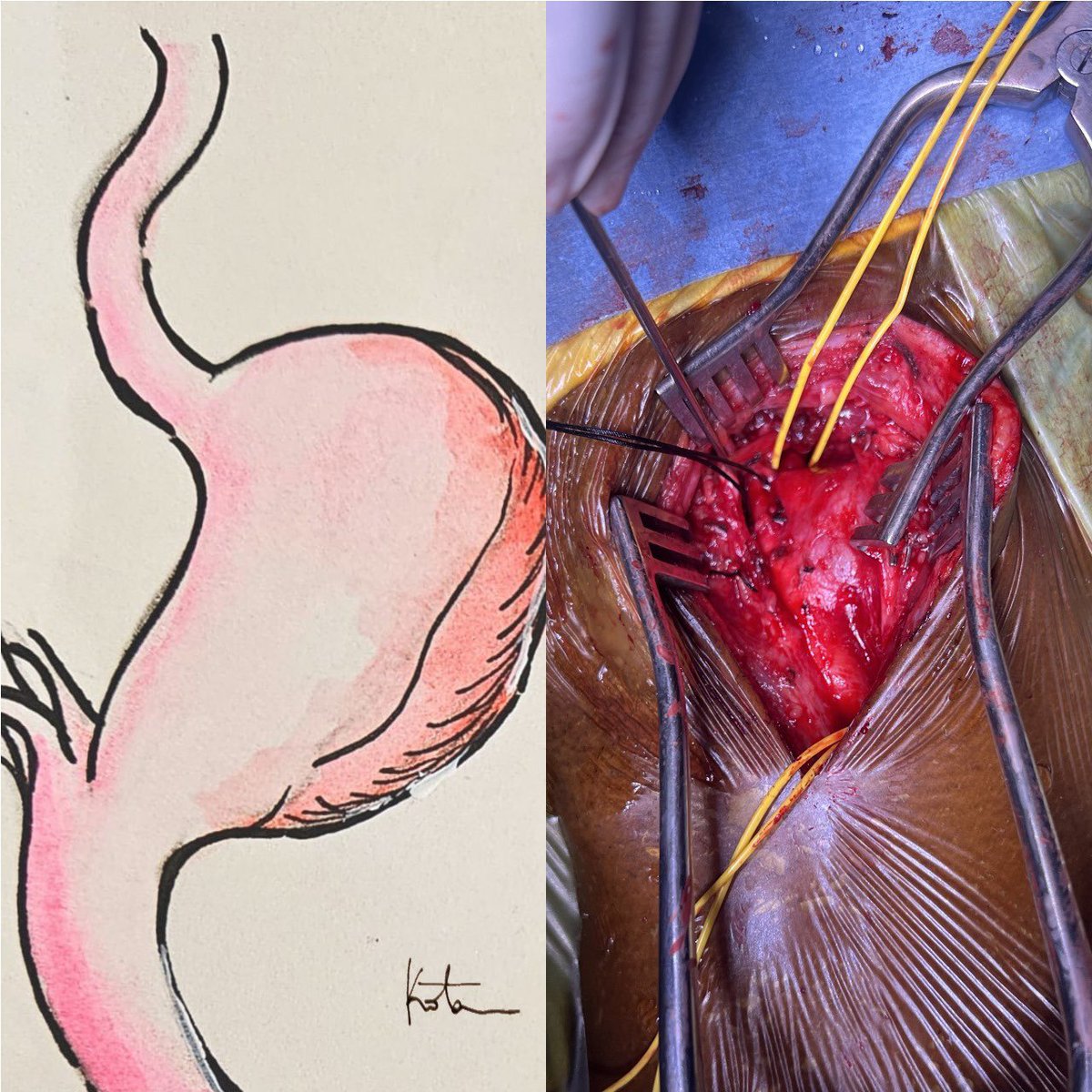 DrPShivanesan (@pshivanesandr) on Twitter photo A 54/M with symptomatic Extra cranial carotid artery aneurysm. Managed with interposition vein graft. Our way for inserting Pruit- Inahara carotid shunt is described in this thread <a href="/PrajnaKota/">Prajna Kota MS, MCh</a> A 54/M with symptomatic Extra cranial carotid artery aneurysm. Managed with interposition vein graft. Our way for inserting Pruit- Inahara carotid shunt is described in this thread <a href="/PrajnaKota/">Prajna Kota MS, MCh</a>