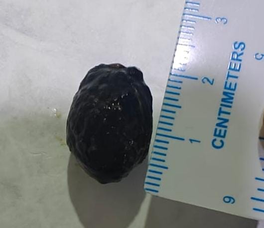 drsunil_bhat's tweet photo. Large CBD stone, Removed by ERCP after EPT and EPLBD @GIscope_updates @EndoCollabcom @GIEndoClinic https://t.co/dyJSCTdMt4