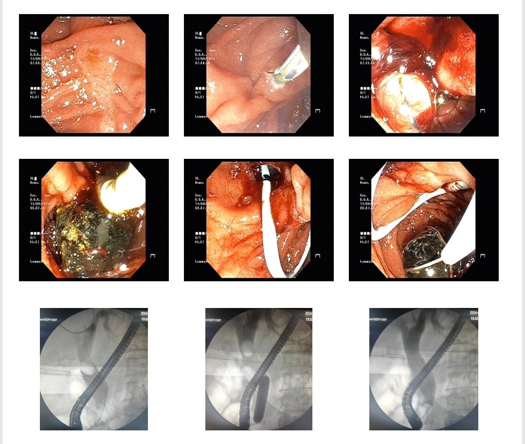 drsunil_bhat's tweet photo. Large CBD stone, Removed by ERCP after EPT and EPLBD @GIscope_updates @EndoCollabcom @GIEndoClinic https://t.co/dyJSCTdMt4