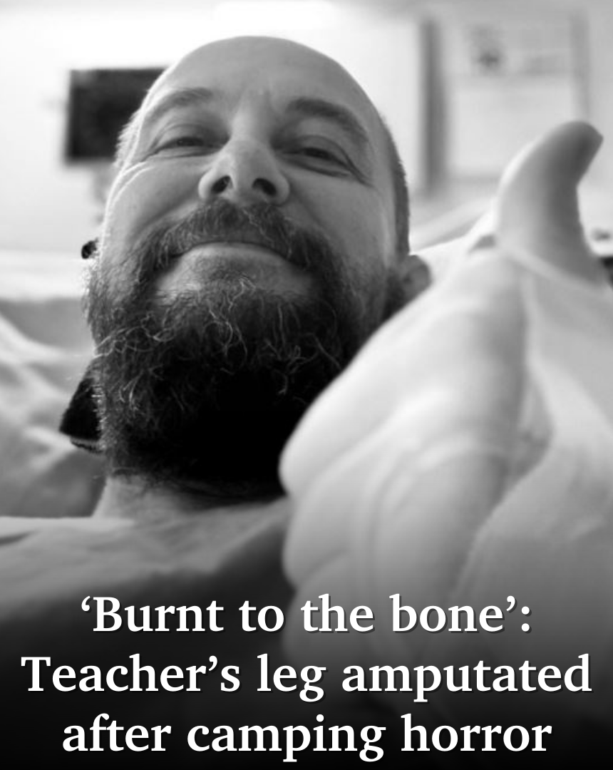 A Sunshine Coast teacher was camping at Stradbroke Island when he tripped over a chair and fell into a fire. It's changed his life forever 🙏💔 FULL STORY&gt;&gt;&gt; bit.ly/47x1JnX