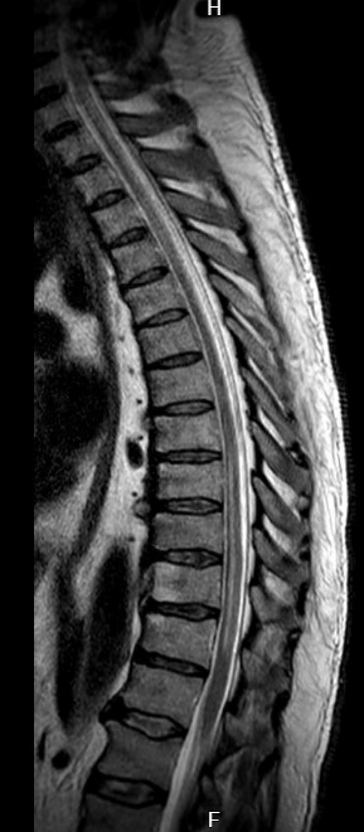 Chr_Schoeps's tweet photo. Eigentlich ne Blickdiagnose, wenn man es kennt:
#NeuroNerd #Neuroradiologie https://t.co/lnuDWGbihl