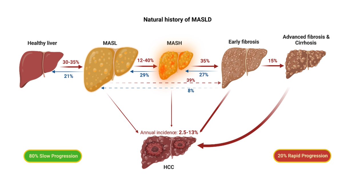 The dynamic progression of #MASLD. ​Over 14 years, 39% of MASLD patients experienced progression, while 35% of MASH patients saw fibrosis progression. Understanding these patterns is crucial for better risk stratification and management. #LiverHealth #MASLD #MASH