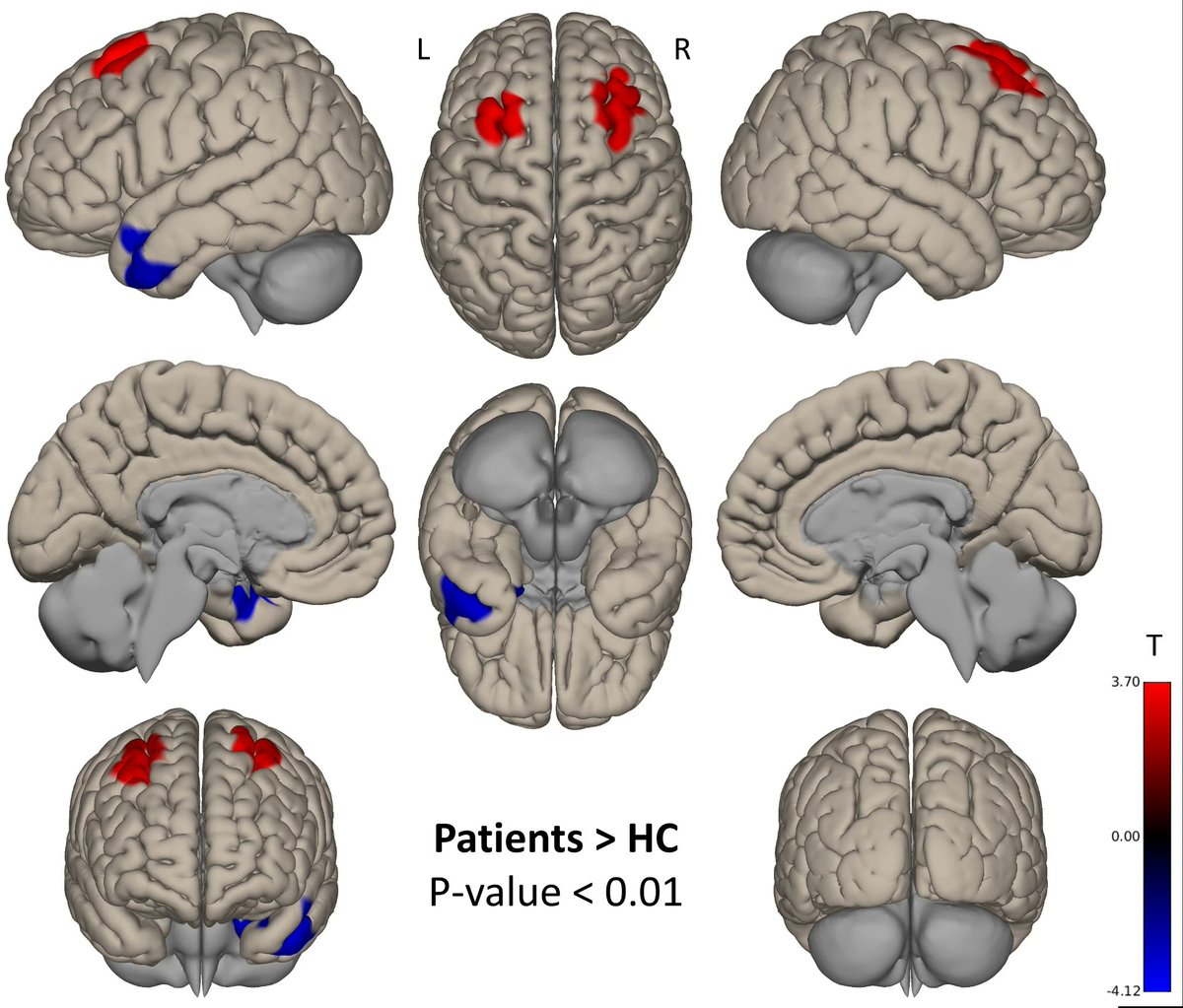 New article alert: 

Bracht et al. report on psychomotor retardation in subjects with severe depression using ASL and BOLD: reduced perfusion in the cingulate motor area and increased connectivity to SMA.
rdcu.be/dUIWV
<a href="/WaltherSeb/">Sebastian Walther</a> <a href="/ScanNeuroradBE/">SCAN Neurorad Bern</a>